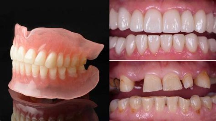 Can I get flexible dentures on NHS?