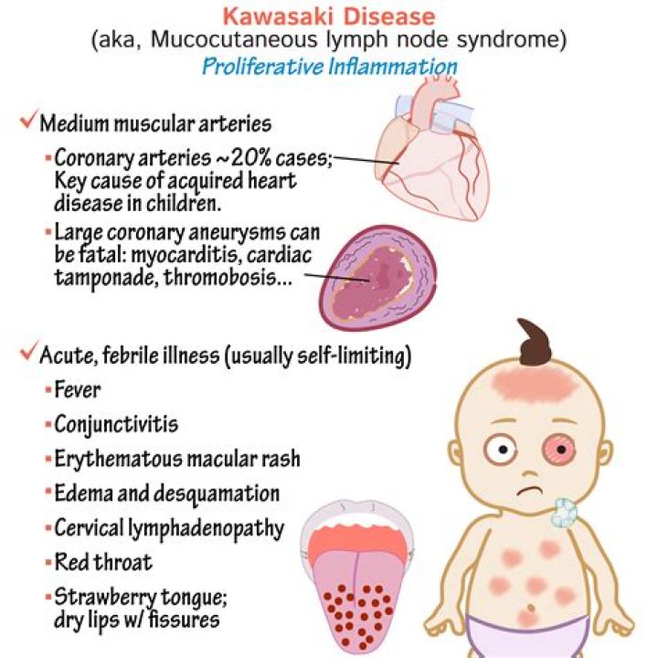 Can Kawasaki disease cause seizures