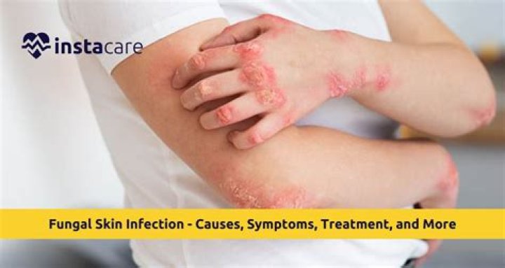 Does diabetes cause fungal infections?