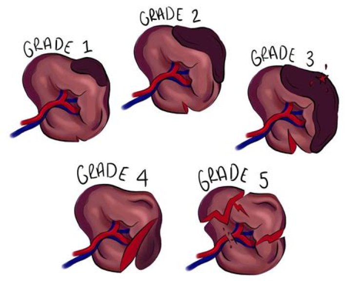 How do you know if you rupture your bladder?