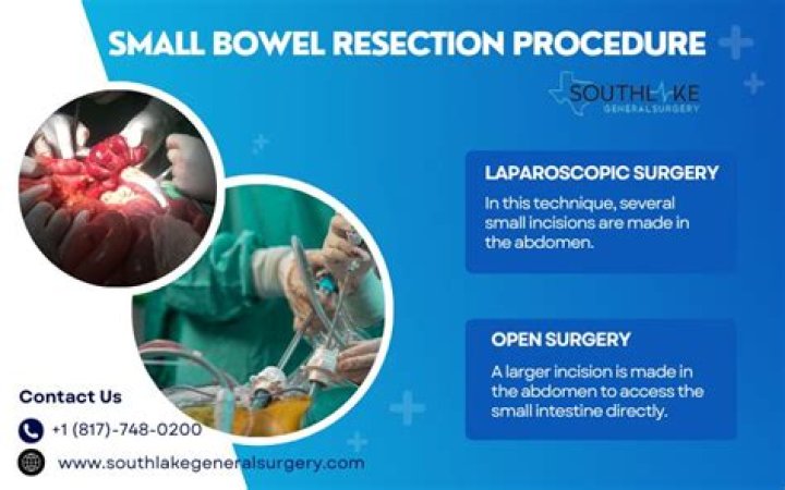 How do you prepare for a bowel resection