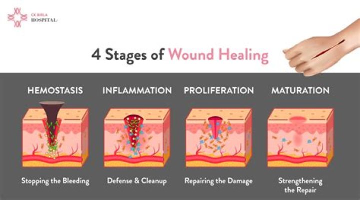 How is a Fistulotomy performed?