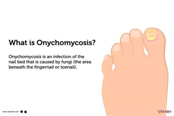 How is onychomycosis diagnosed