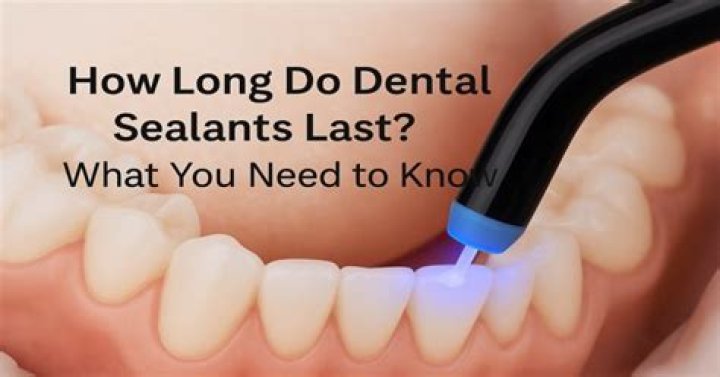 How long do dental sealants last?