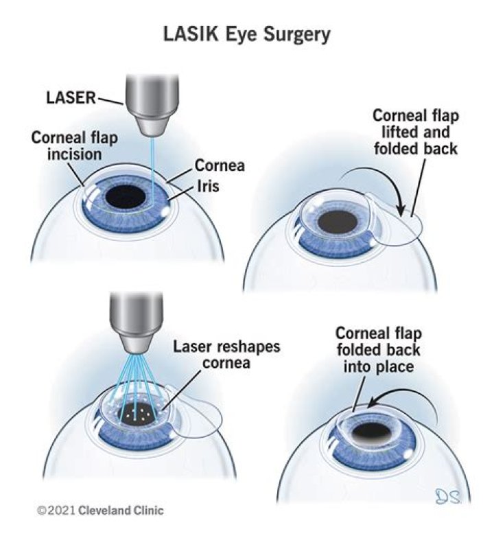 What are the disadvantages of laser eye treatment?