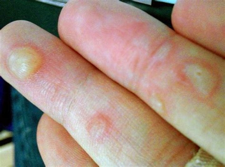 What causes blisters on fingertips?