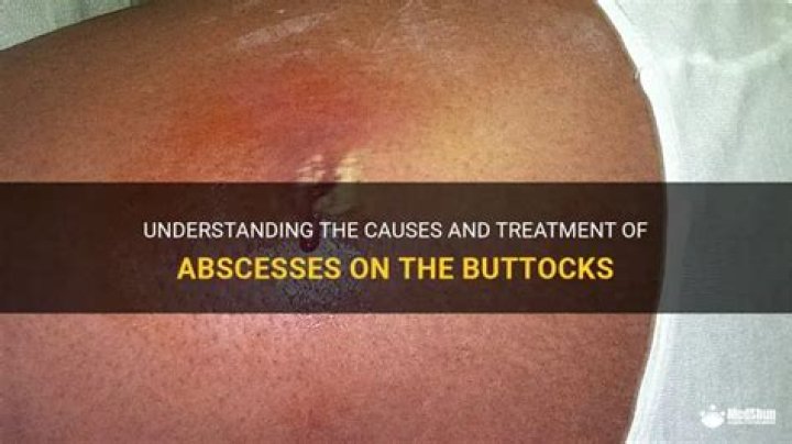 What causes cutaneous abscess of buttock