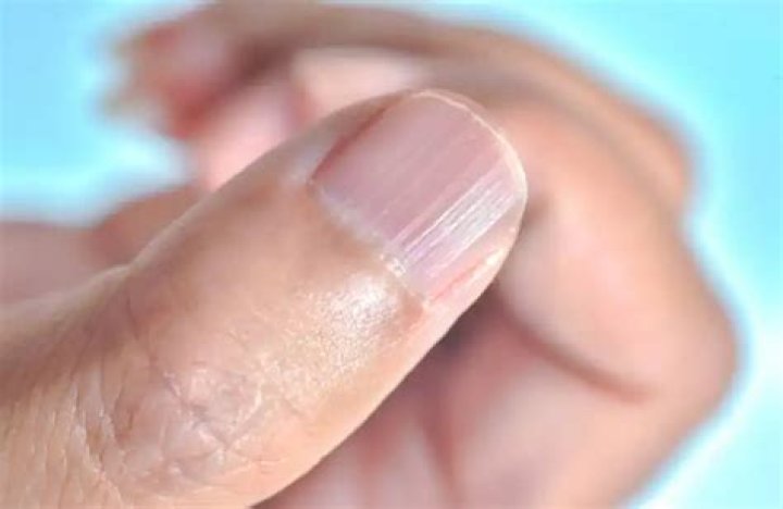 What causes ridges on your fingernails?