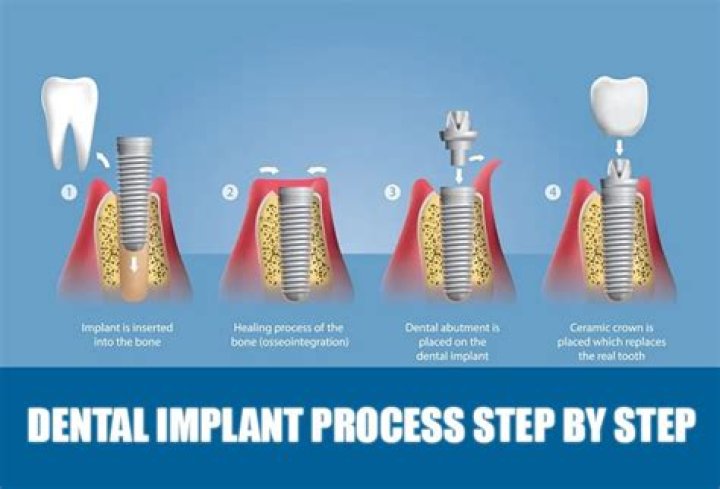What do pec implants feel like?