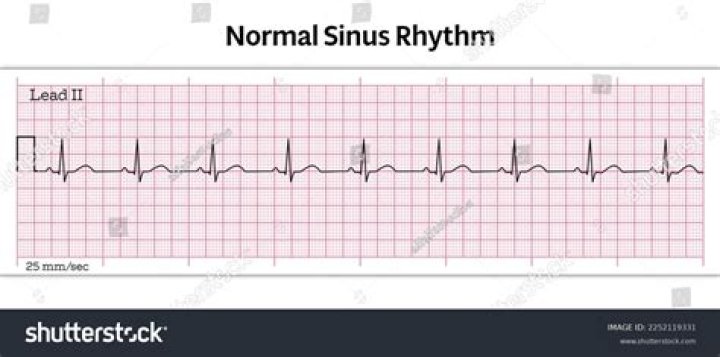What does a normal sinus rhythm look like