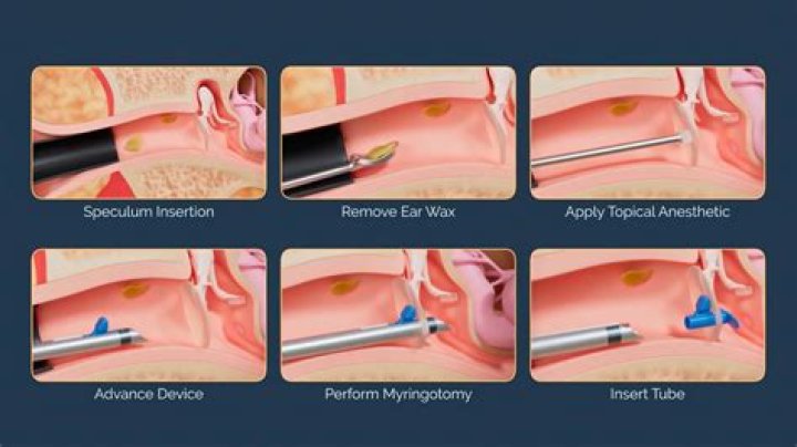 What is a Tympanotomy procedure?