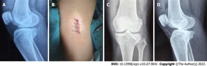 What is an avulsion fracture of the patella