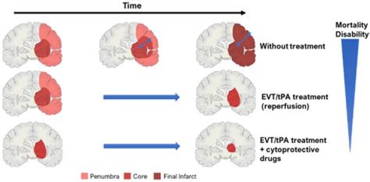 What is an example of an early complication of an ischemic stroke