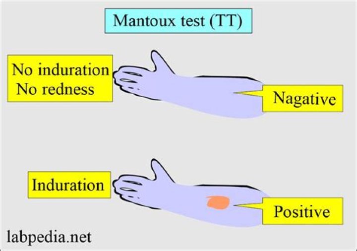 What is induration in TB test?