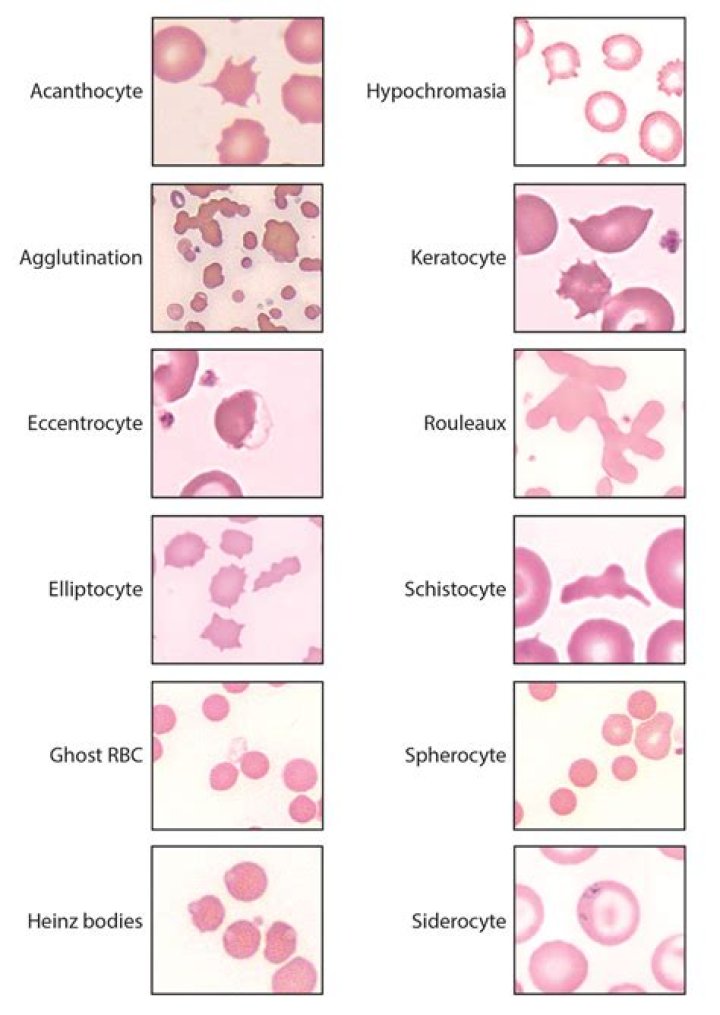What is Schistocytes blood test