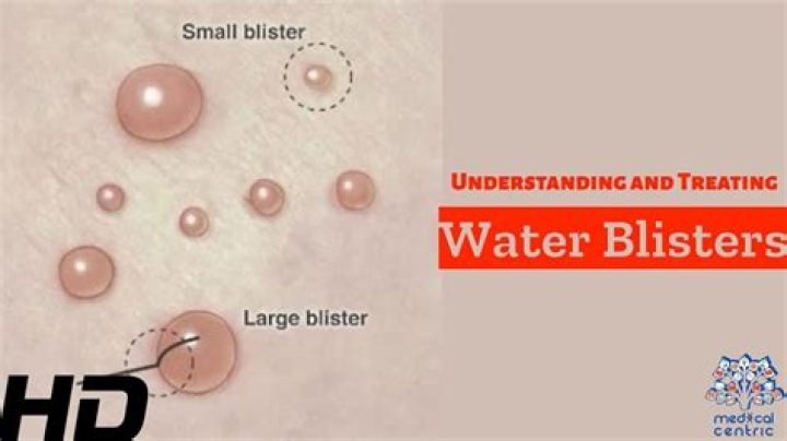 What is the fluid inside a blister?