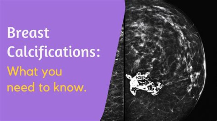 What percentage of breast calcifications are cancerous?