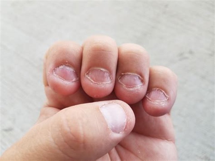 Why do I chew my nails?