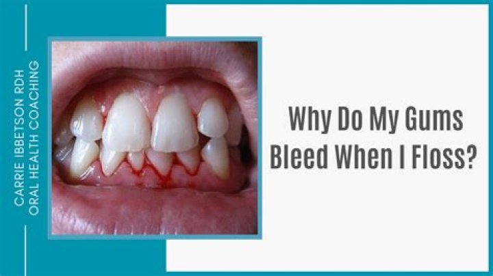 Why do my gums feel weird after flossing?